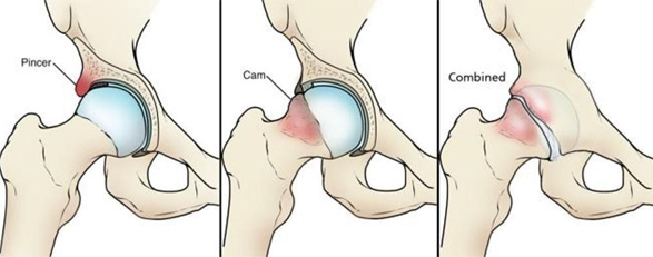 femoroacetabular-impingement